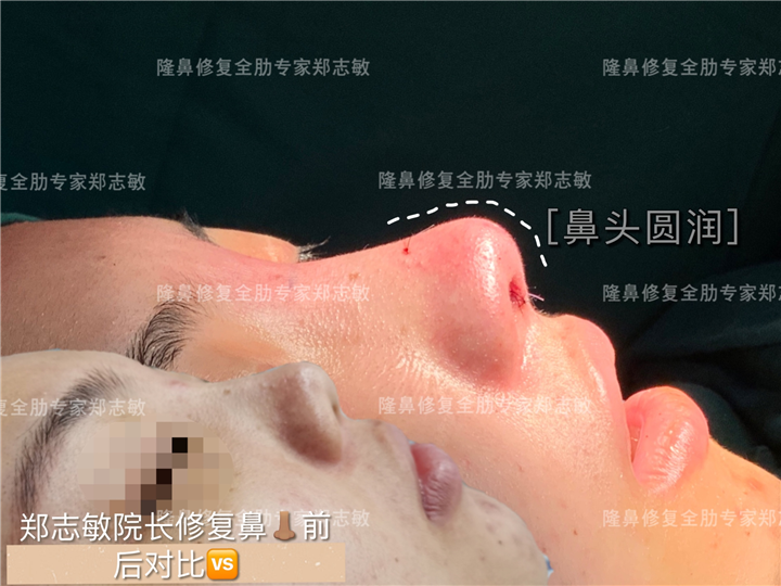 广州郑志敏医生全肋鼻整形案例 