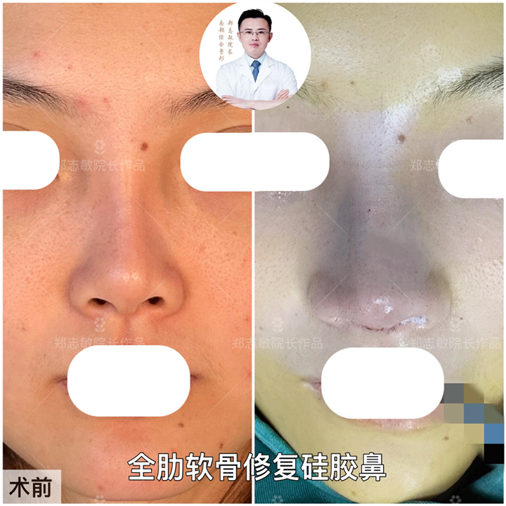 郑志敏全肋软骨修复硅胶鼻案例