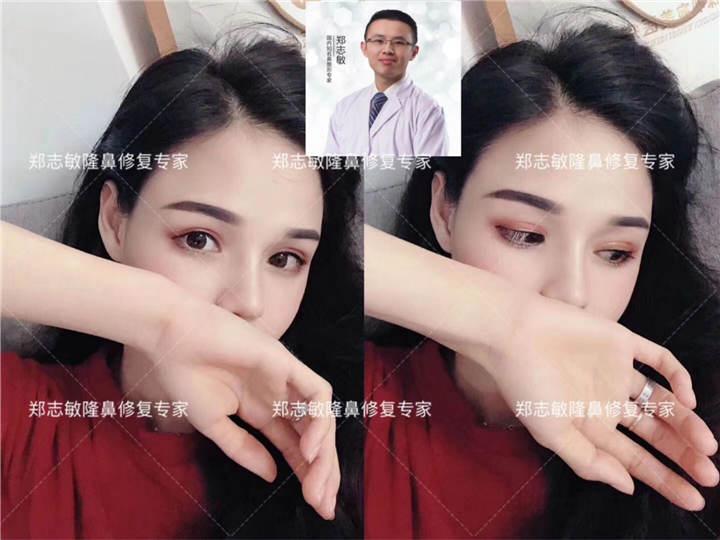 广州隆鼻修复专家 