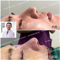 郑志敏隆鼻修复
