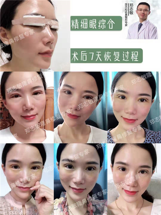 广州精细眼综合整形 