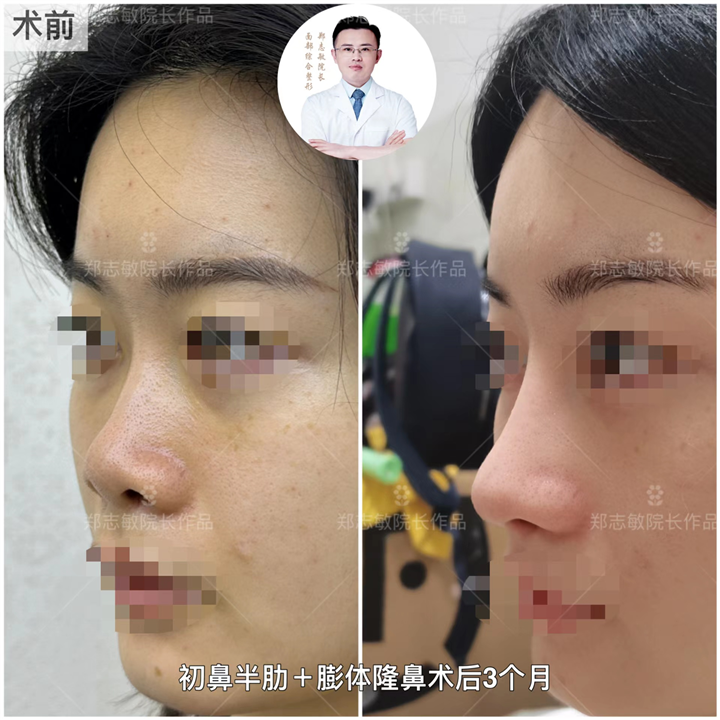 广州郑志敏医生半肋隆鼻案例