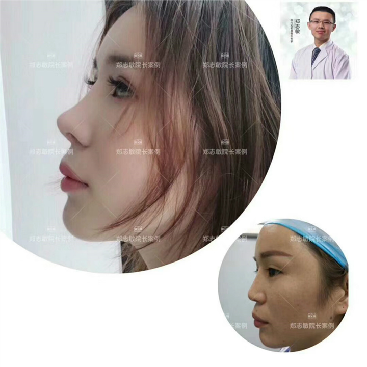 广州隆鼻整形 