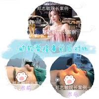 广州肋软骨隆鼻 