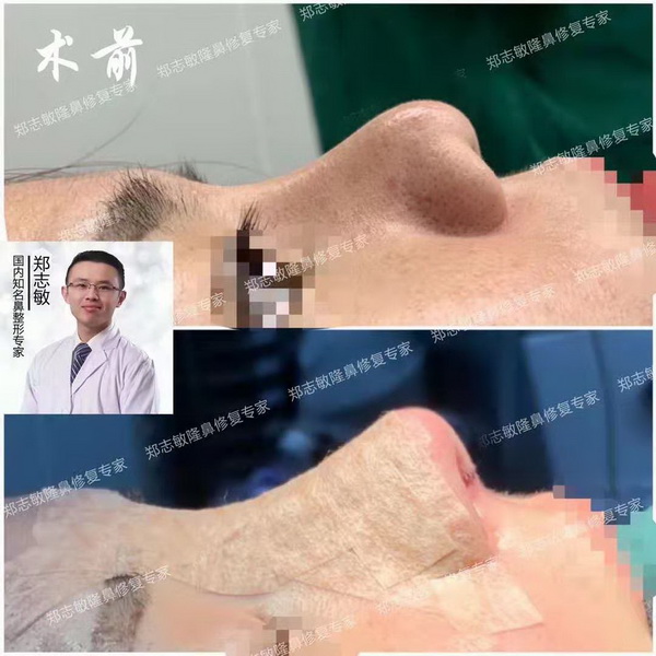 郑志敏肋骨鼻修复