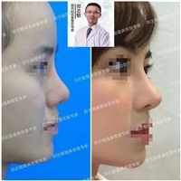 郑志敏肋骨鼻修复专家 