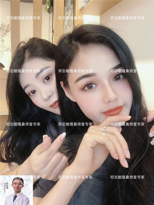 广州隆鼻修复哪家好 