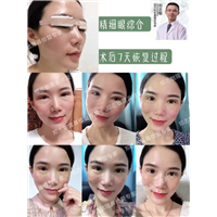 广州精细眼综合整形 