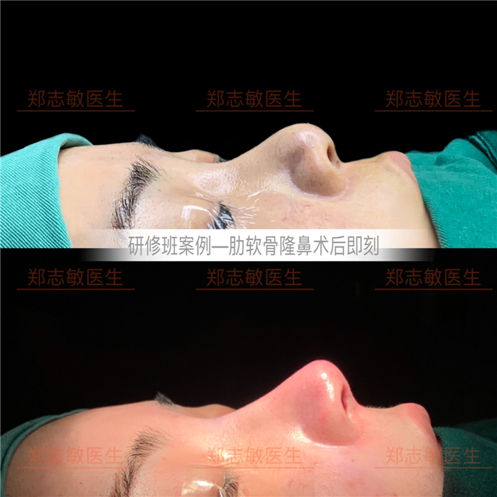 鼻整形研修班肋软骨隆鼻案例术后即刻效果 