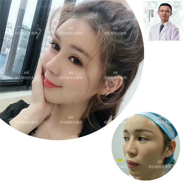 广州鼻整形修复 