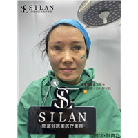 思蓝鱼骨筋膜悬吊提升