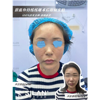 思蓝鱼骨线线雕术后即刻