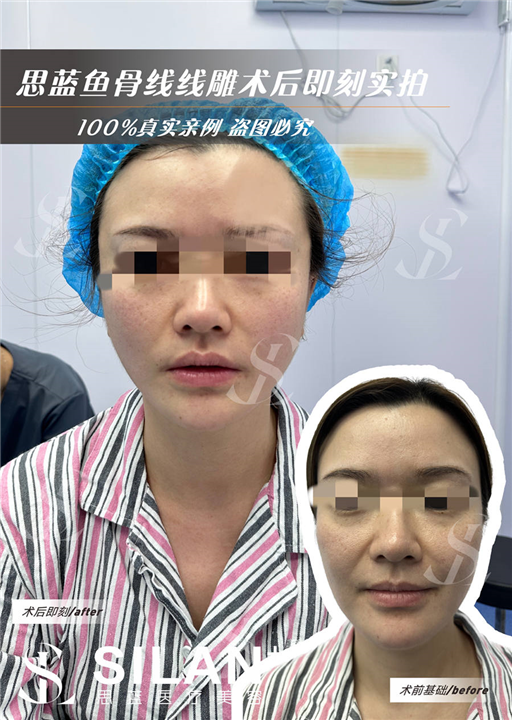 思蓝鱼骨线线雕术后即刻