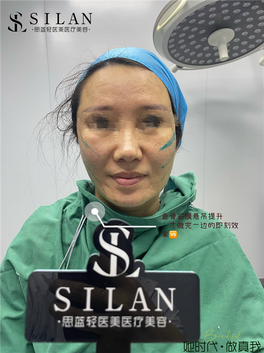 思蓝鱼骨筋膜悬吊提升