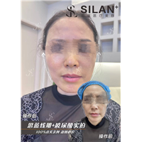 思蓝线雕+玻尿酸