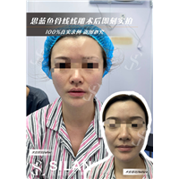 思蓝鱼骨线线雕术后即刻