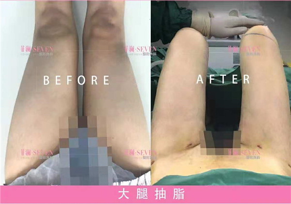 长沙吸脂整形医院哪家好