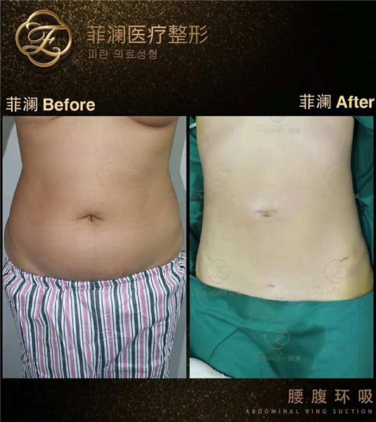 长沙腰部吸脂整形哪里好