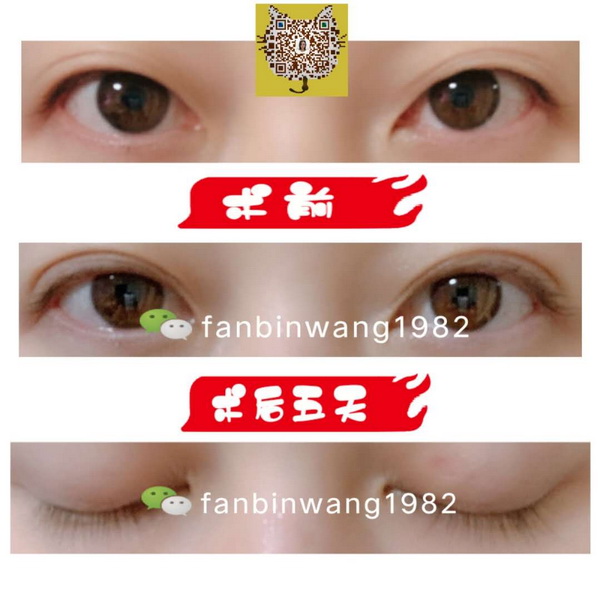 日式无痕双眼皮