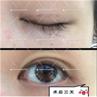 上海日式无痕双眼皮