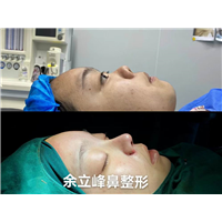 余立峰鼻综合