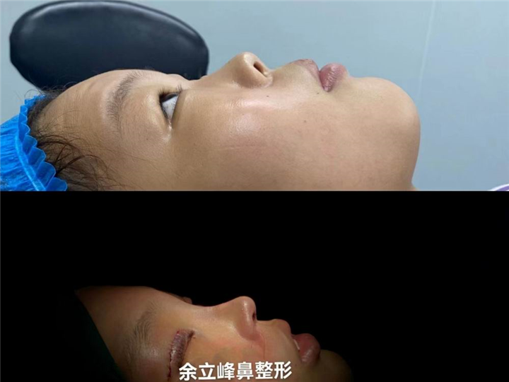余立峰鼻综合整形