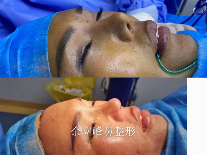 郑州鼻整形修复医生