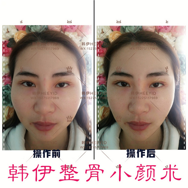 青岛日式小颜整骨培训