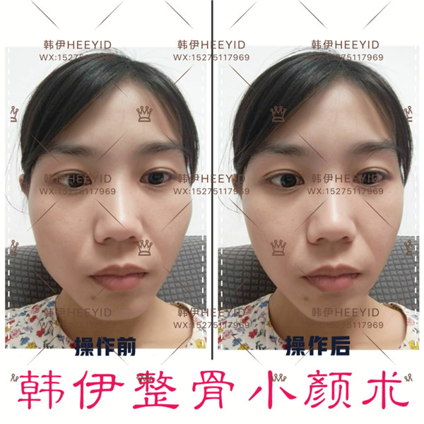 青岛日式小颜整骨培训
