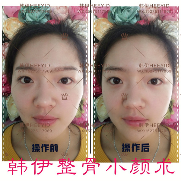 青岛日式小颜整骨培训