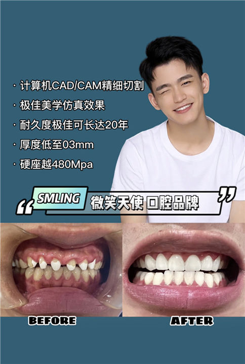 微笑天使口腔医院做全瓷贴面贵不贵