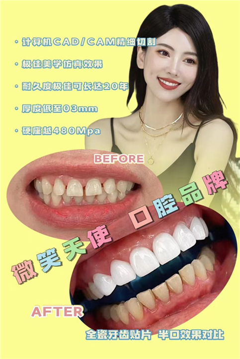 关于瓷贴面技术介绍