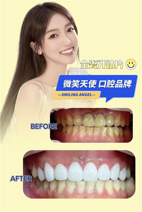 上海哪里做牙齿贴面比较好谁知道