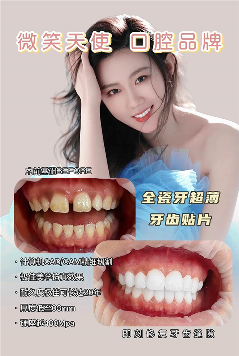 上海做全瓷贴面哪家好