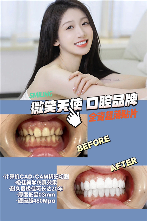 完成瓷贴面需要几个步骤?