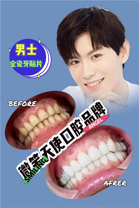 牙齿美白瓷贴面好不好