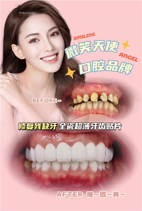 瓷贴面,有她您不必再遮挡您的笑容