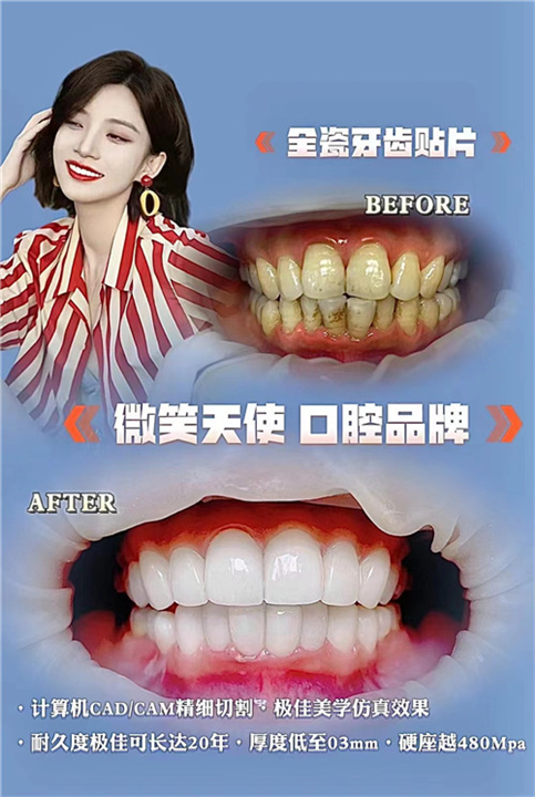 瓷贴面修复牙齿多少钱