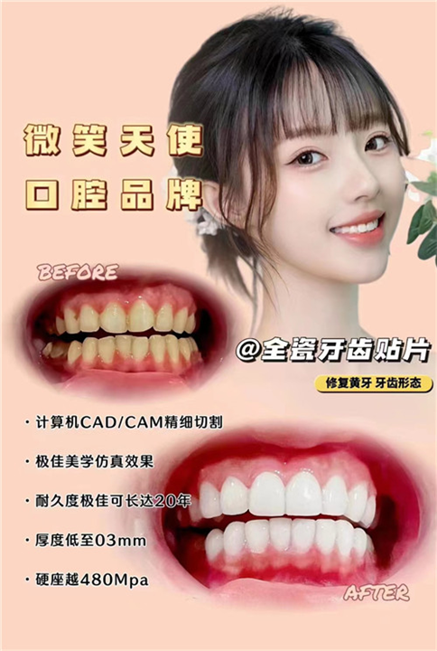 牙齿美白瓷贴面好不好