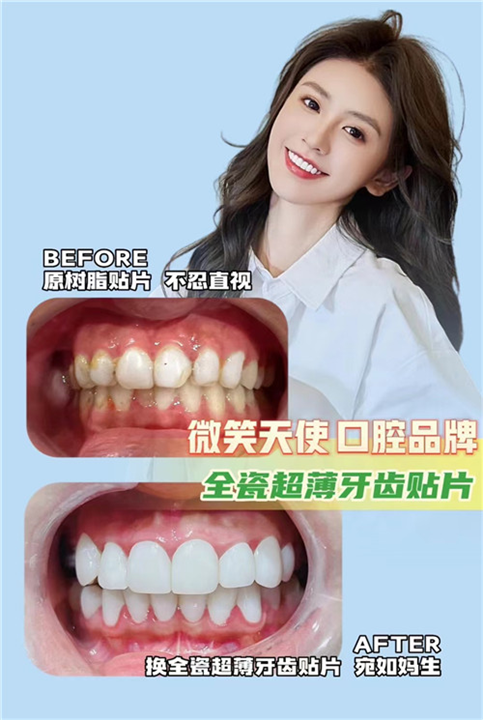 【牙齿全瓷贴面 】