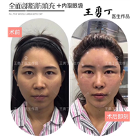成都自体脂肪填充哪家好