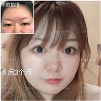 成都眼综合整形