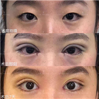 王勇丁眼部整形