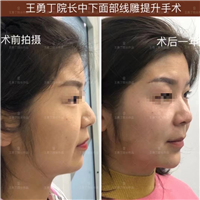 成都面部线雕抗衰