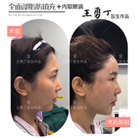 王勇丁整形案例