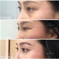 成都眼袋整形专家