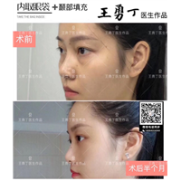 王勇丁自体脂肪填充专家