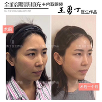 快速摆脱熊猫眼、成都专业祛眼袋整形专家
