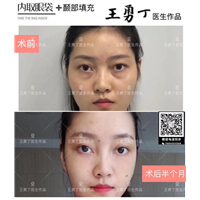 成都自体脂肪填充整形专家
