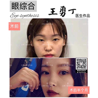 王勇丁眼部整形